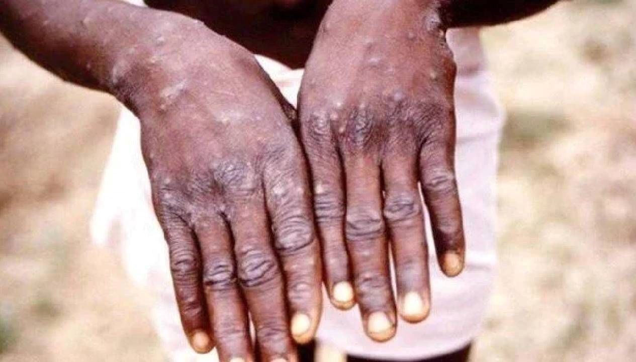 ganada m cicegi vaka sayisi 565e cikti YV4BrRsJ